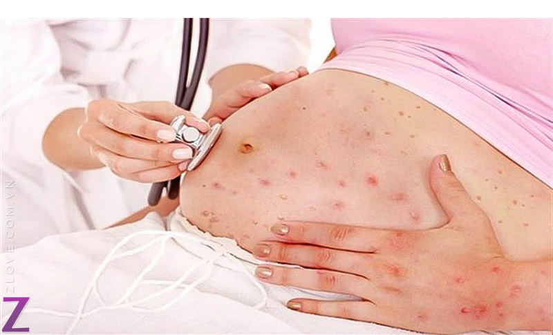 cách phòng ngừa rebulla cho phụ nữ mang thai