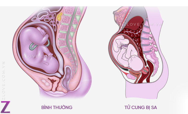 Sa tử cung khi mang thai nguy hiểm như thế nào, có sinh thường ...