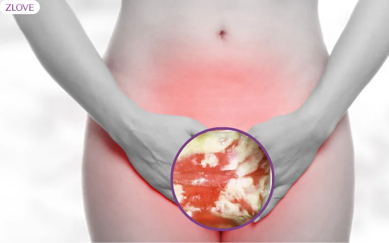 Nấm âm đạo candida