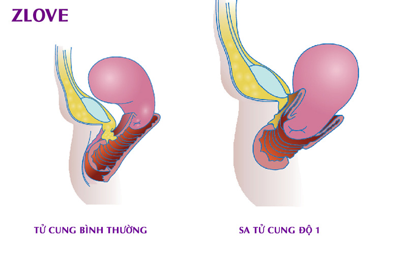 Sa tử cung có mấy cấp độ? Sa tử cung độ mấy thì cần phẫu thuật ...