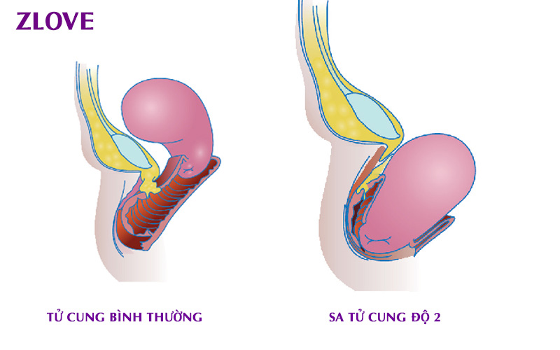 Sa tử cung có mấy cấp độ? Sa tử cung độ mấy thì cần phẫu thuật ...