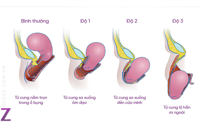 sa tử cung bao gồm 3 cấp độ từ nhẹ đến nặng